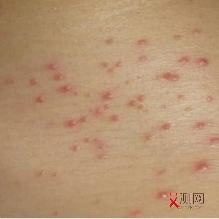 得了艾滋病图片是怎样的症状