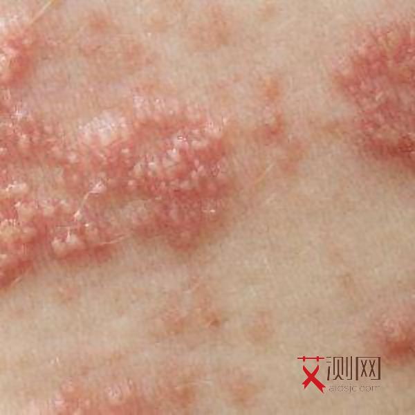 艾滋病潜伏期一般是多少年?