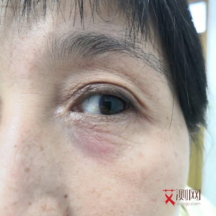 男性艾滋病是什么症状反应