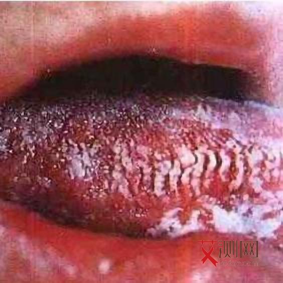 刚刚感染艾滋病怎么办