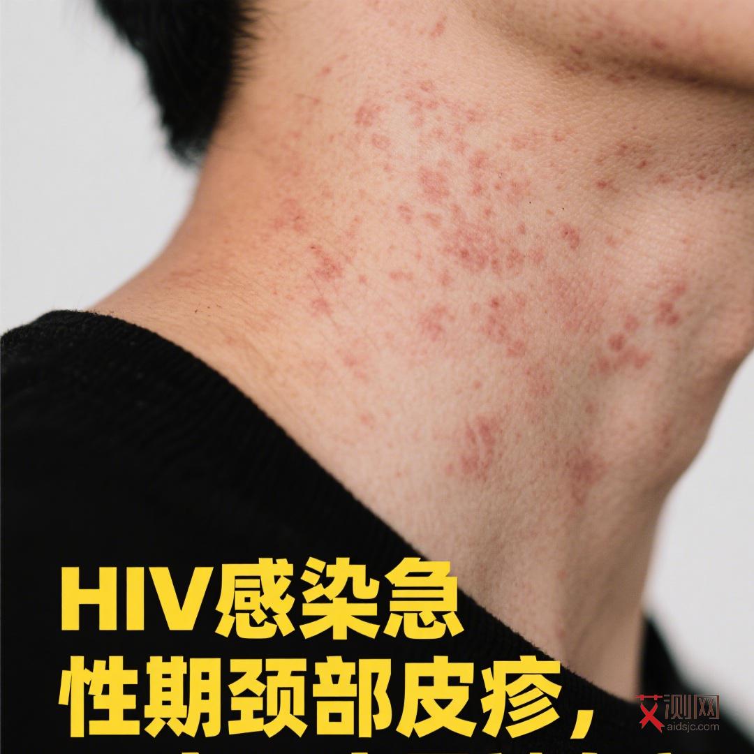 艾滋病白色念珠菌感染