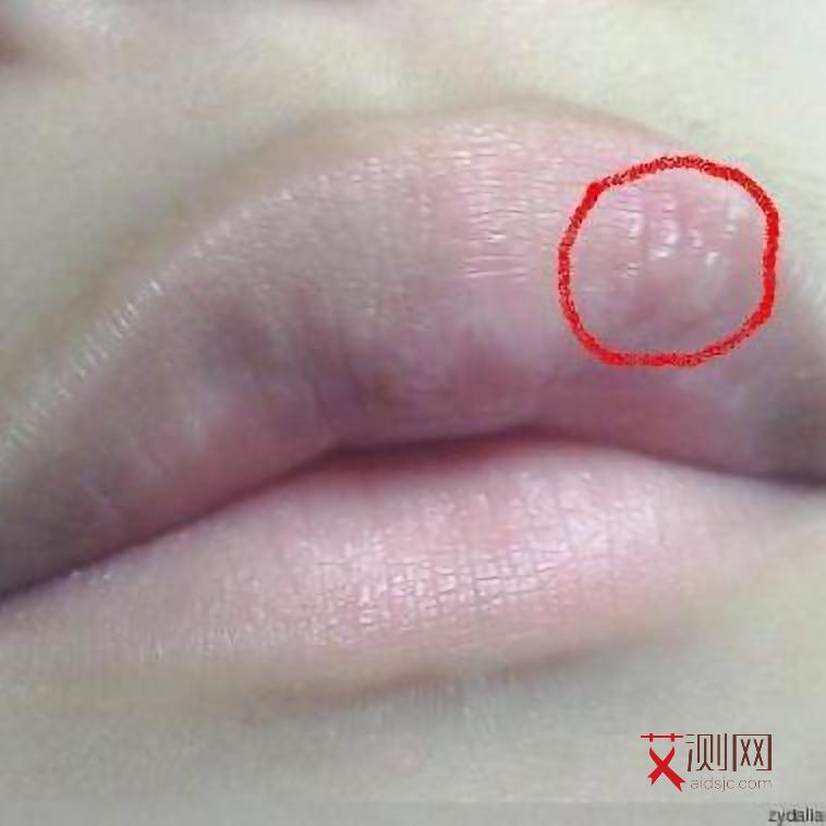 艾滋病病毒感染前期症状