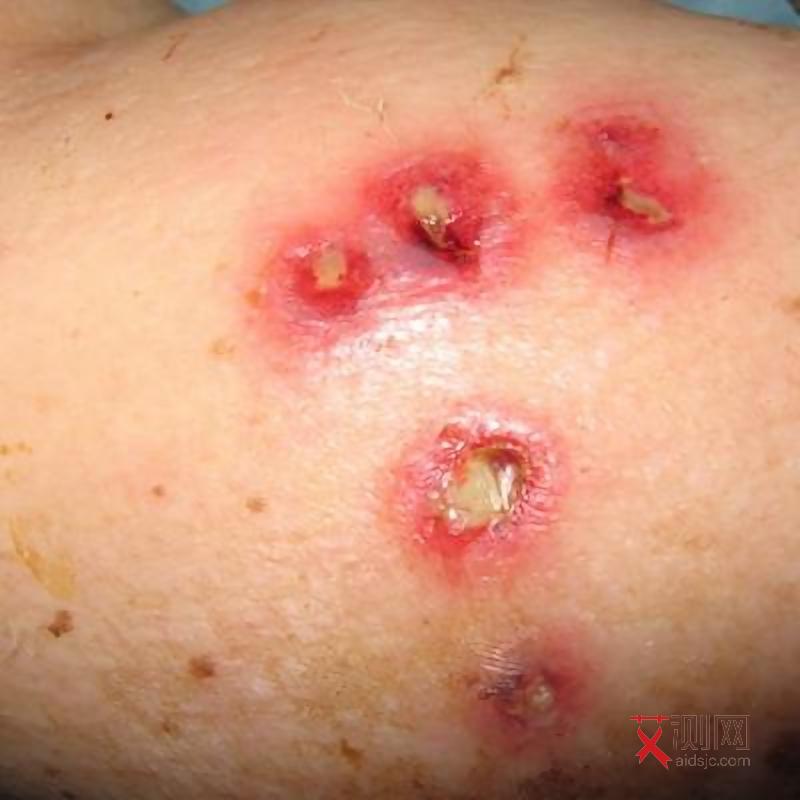 北京艾滋病患者有多少2025