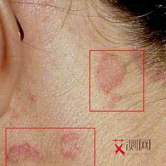 艾滋病的初期皮疹图片女性怎么治疗好呢