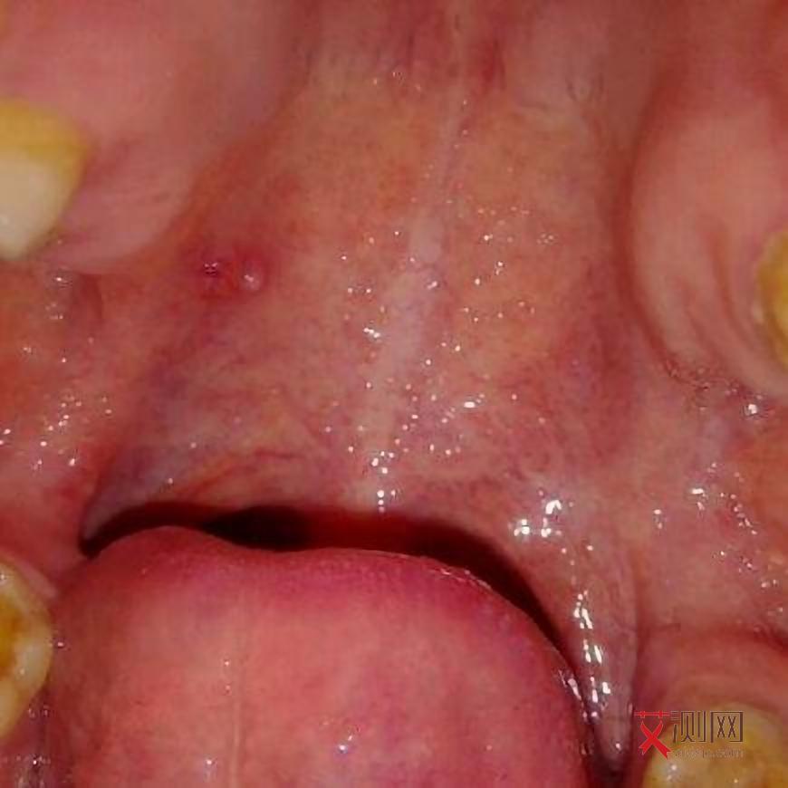 艾滋病多久才有感觉和症状呢