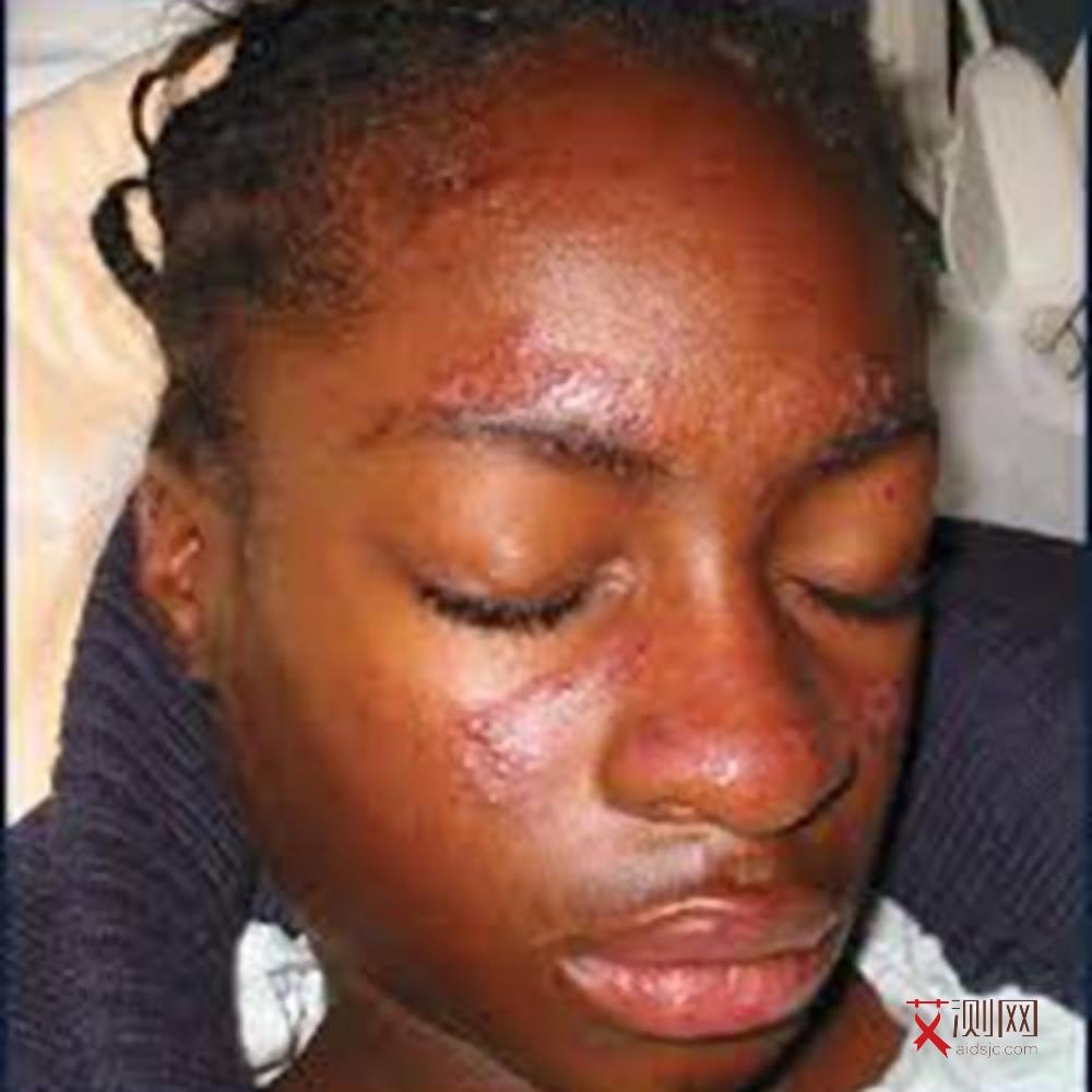 艾滋病起小红点会痛痒吗会传染吗