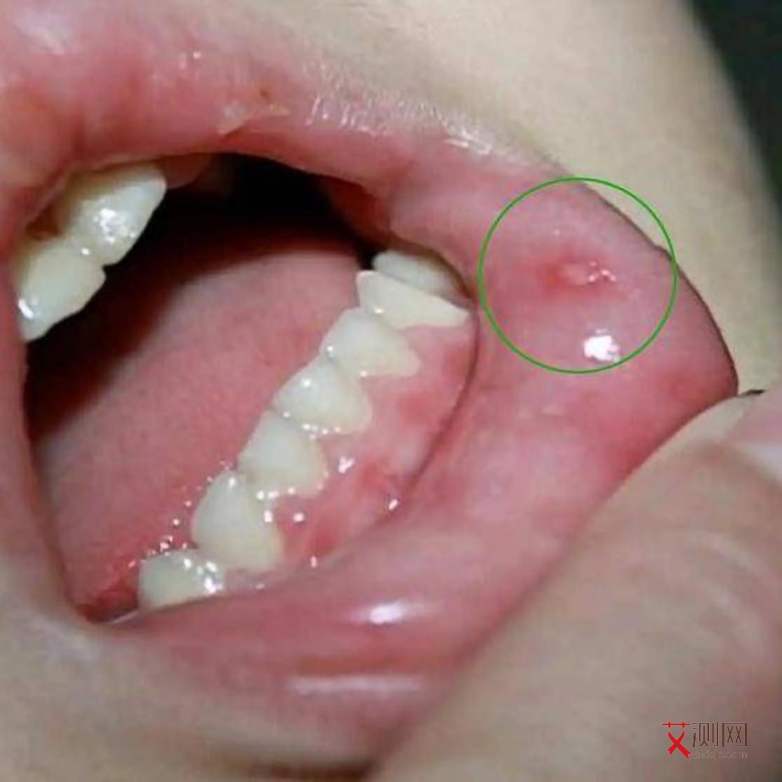 艾滋病最快多久会出现症状表现呢