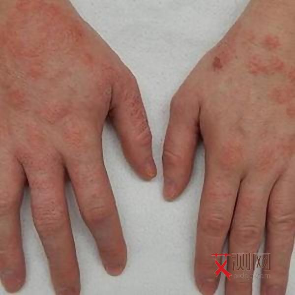 艾滋病皮肤破溃图片大全