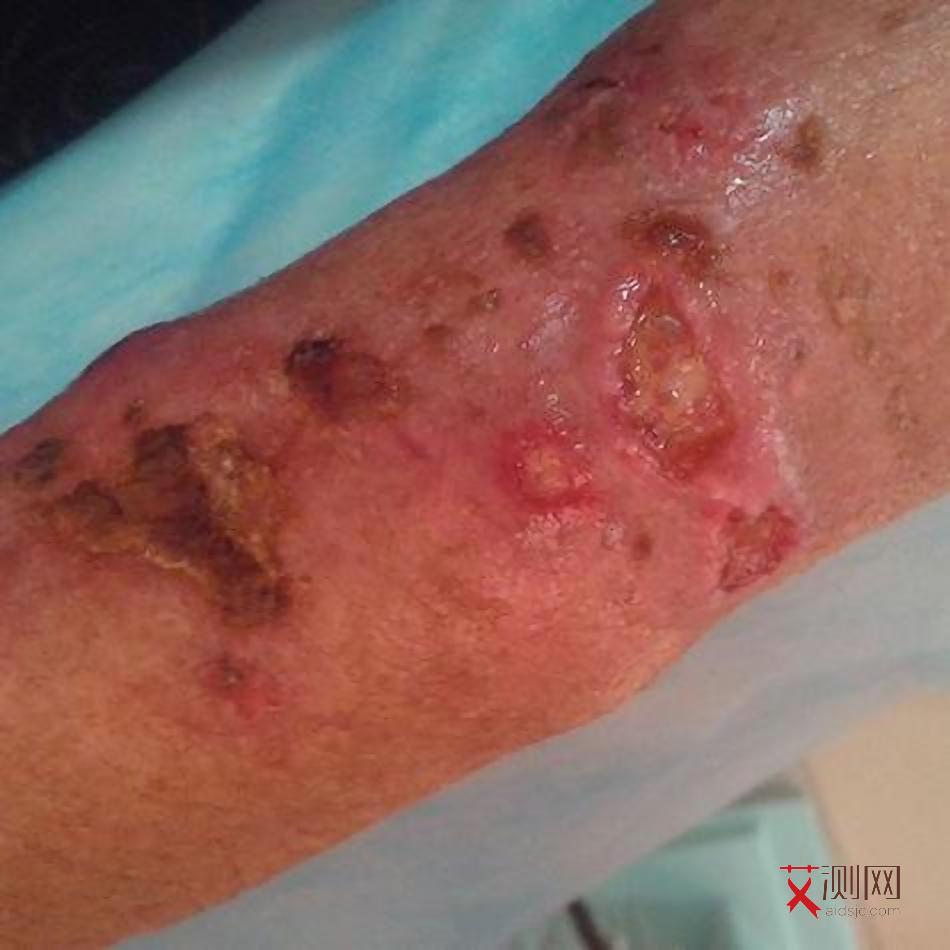 艾滋病多久才发现出来症状