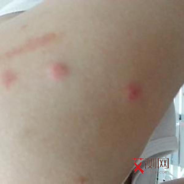 艾滋病有何表现症状男性