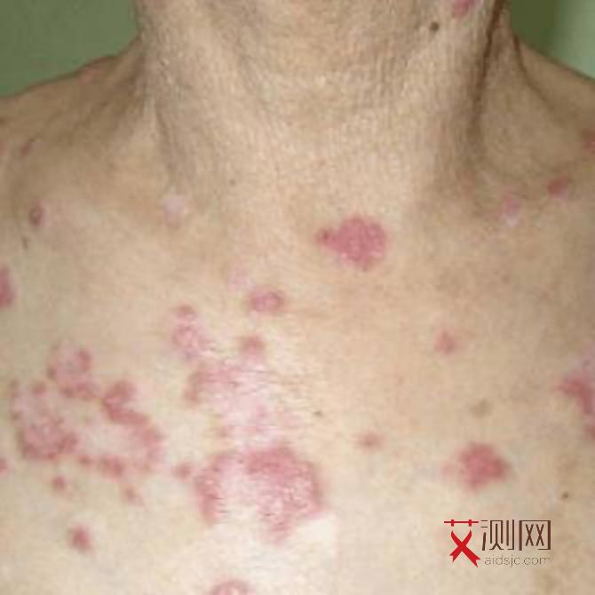 艾滋病初期的皮疹是一两颗还是很多颗