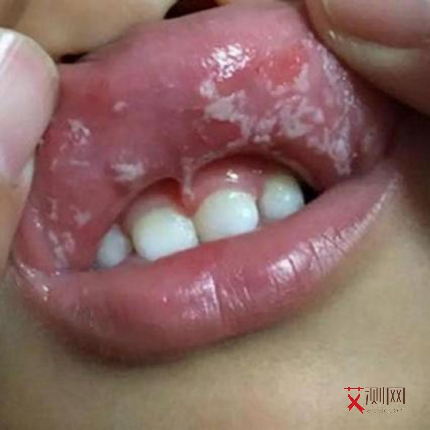 艾滋病女性症状初期征兆表现是什么