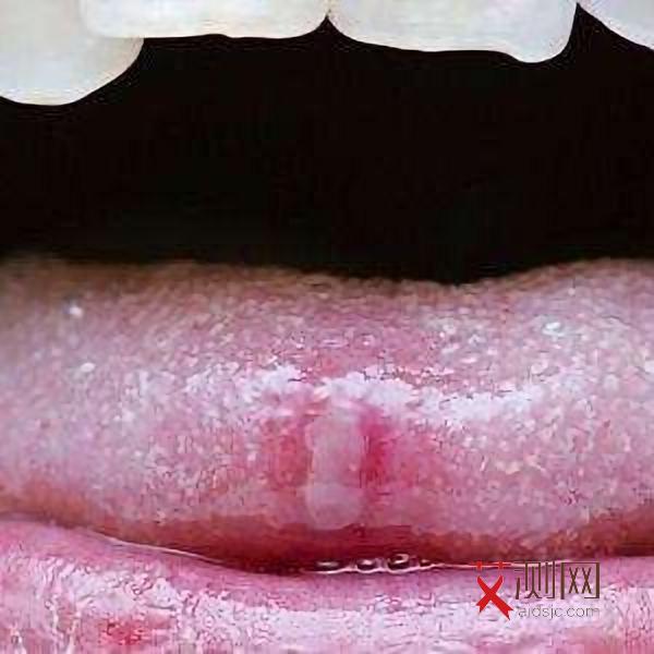 艾滋病出现皮疹会有其他并发症吗