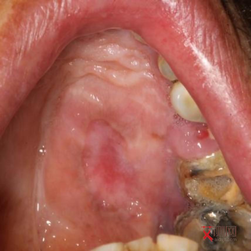 的艾滋病下面什么症状都没有吗女性会传染吗图片