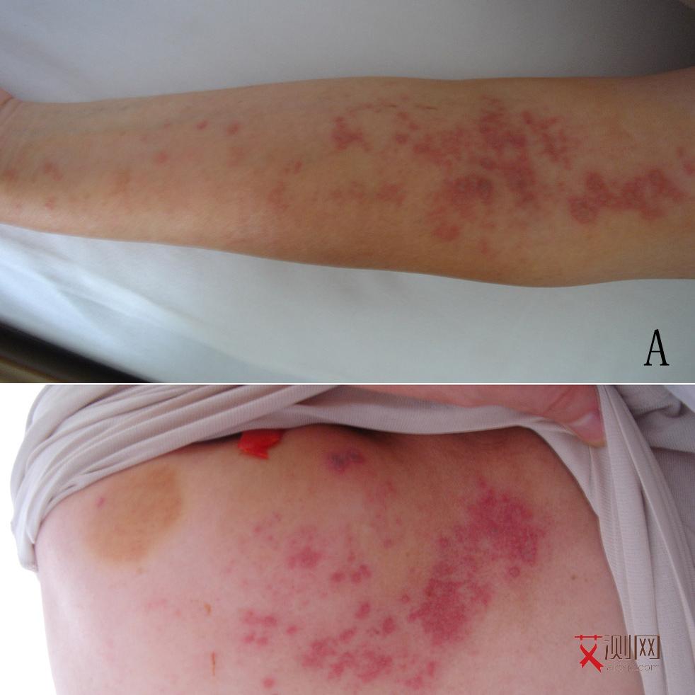 得了艾滋病人有哪些症状表现呢女性