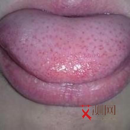 艾滋病人小红点会在哪个部位