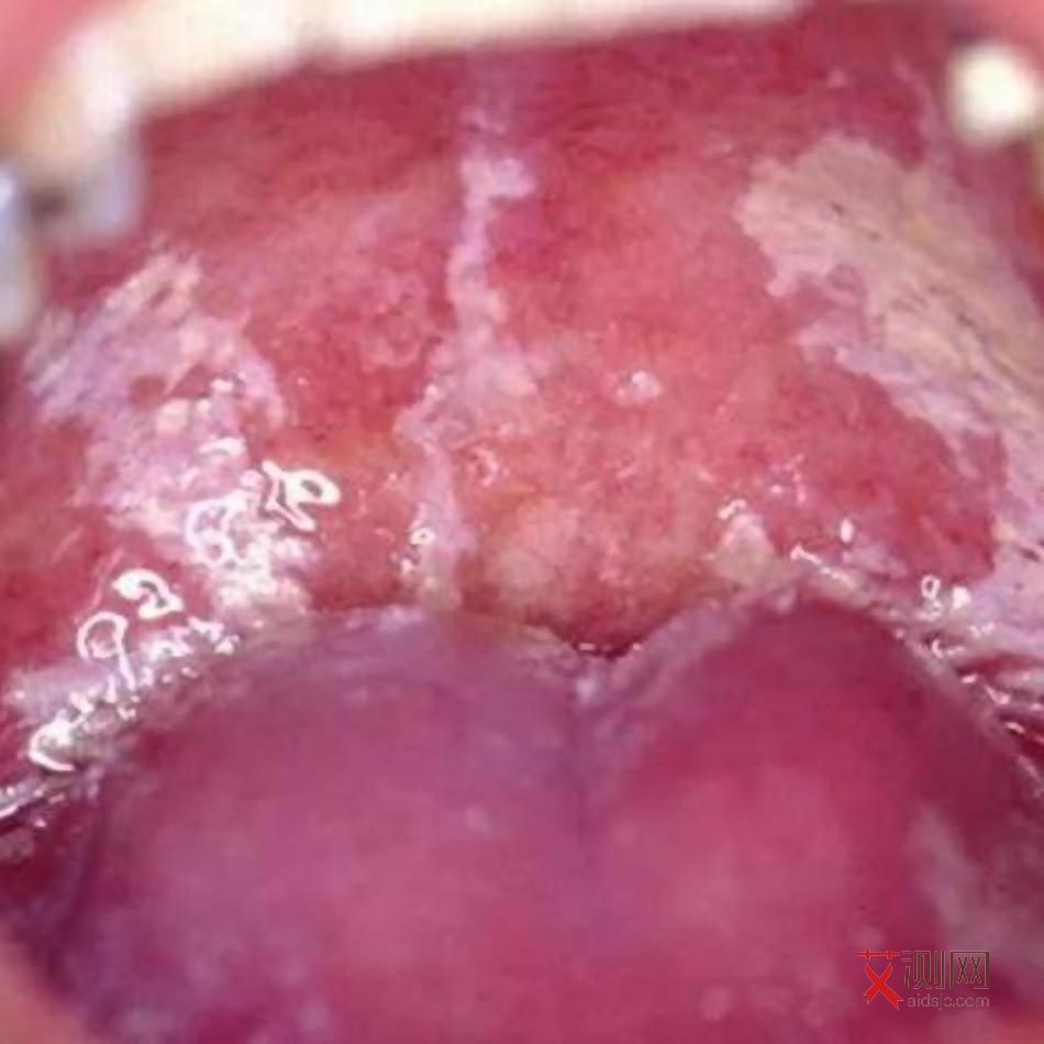 感染艾滋病毒下面会痒吗女性