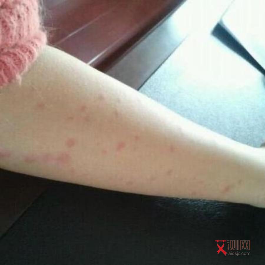 女生艾滋病身上会起什么疹子图片和症状