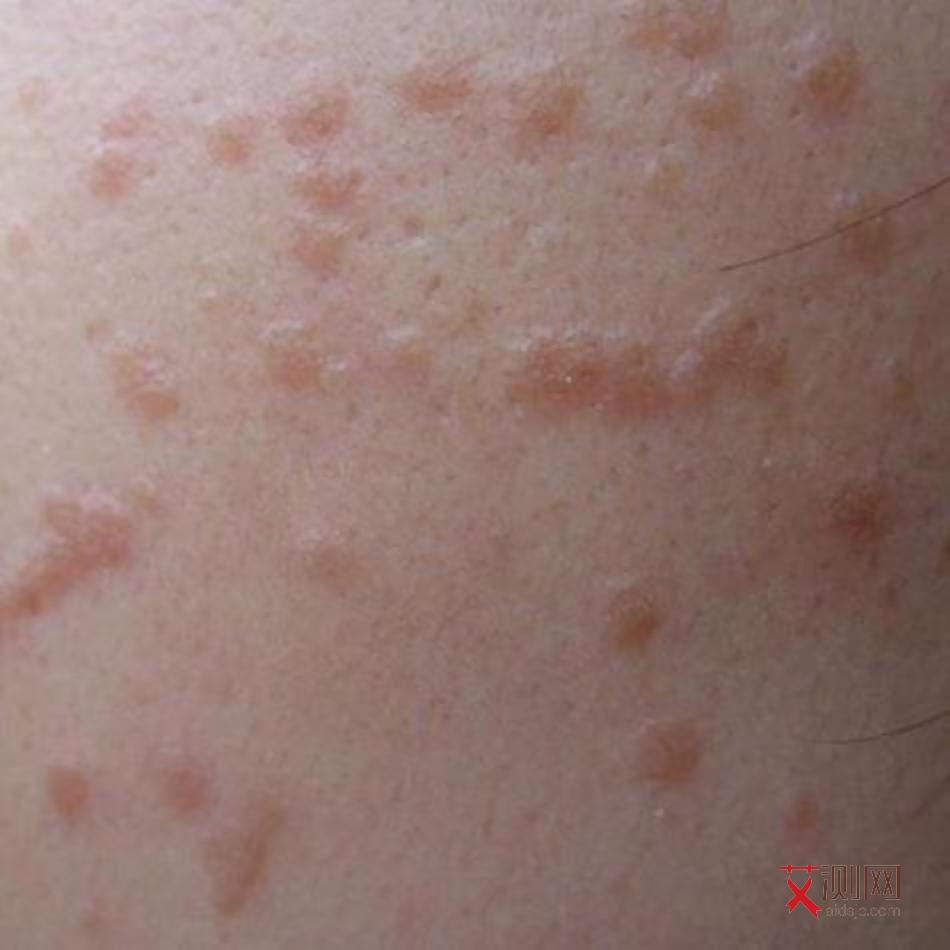 牙龈出血会感染艾滋病吗