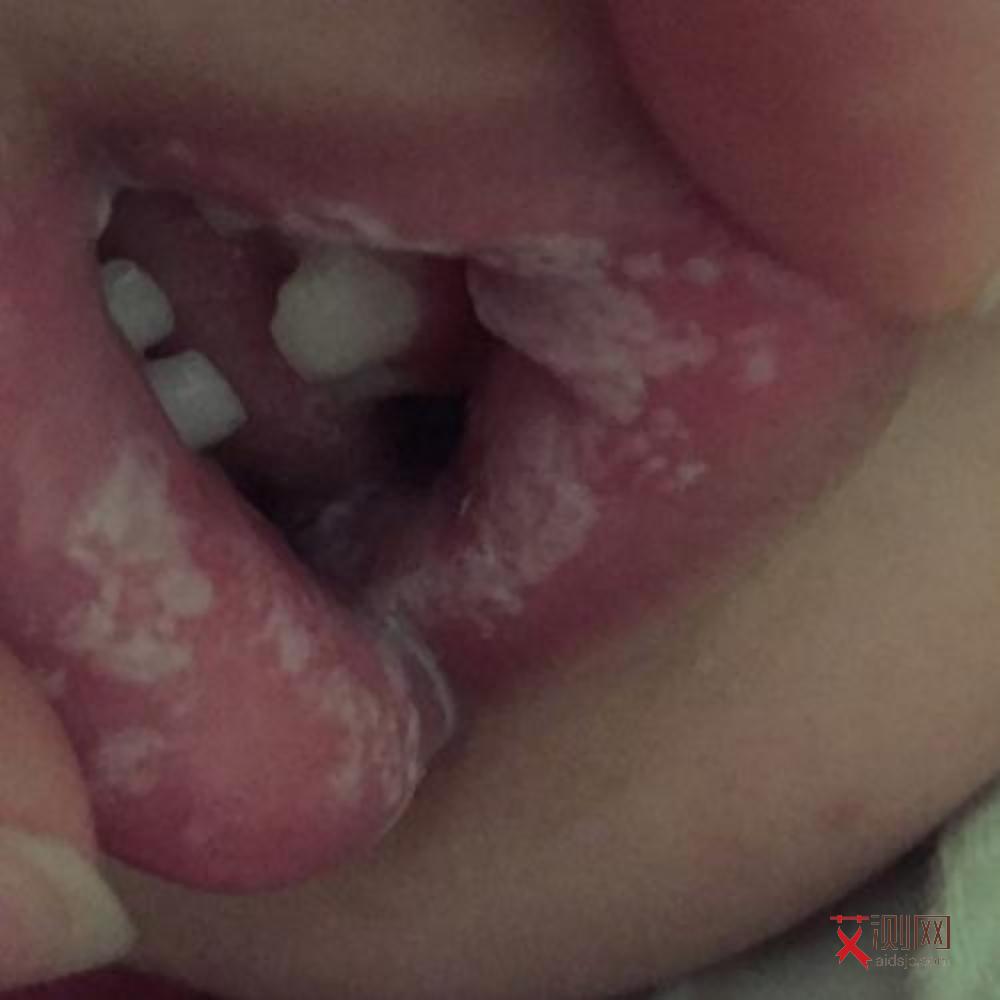 男性得艾滋病多久出现症状