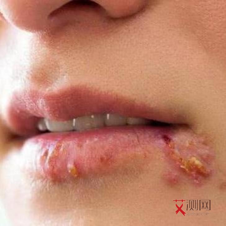 得了艾滋病有什么症状皮肤会痒也不来月经