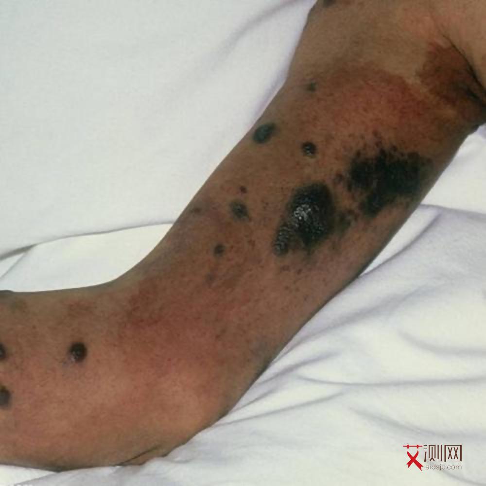 艾滋病会有什么症状图片