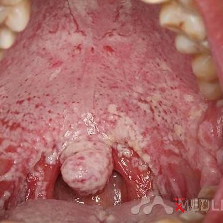 艾滋病过几天才有症状