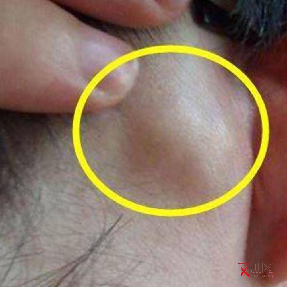 艾滋病症状大全图女性早期