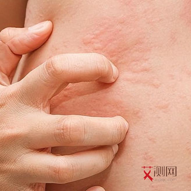 艾滋病初期是什么样的感觉和症状