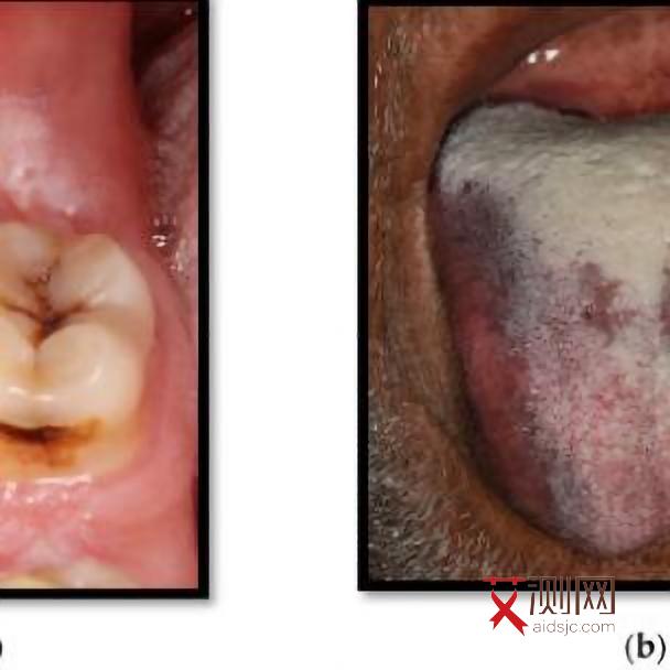 艾滋病的胸痛具体表现包括