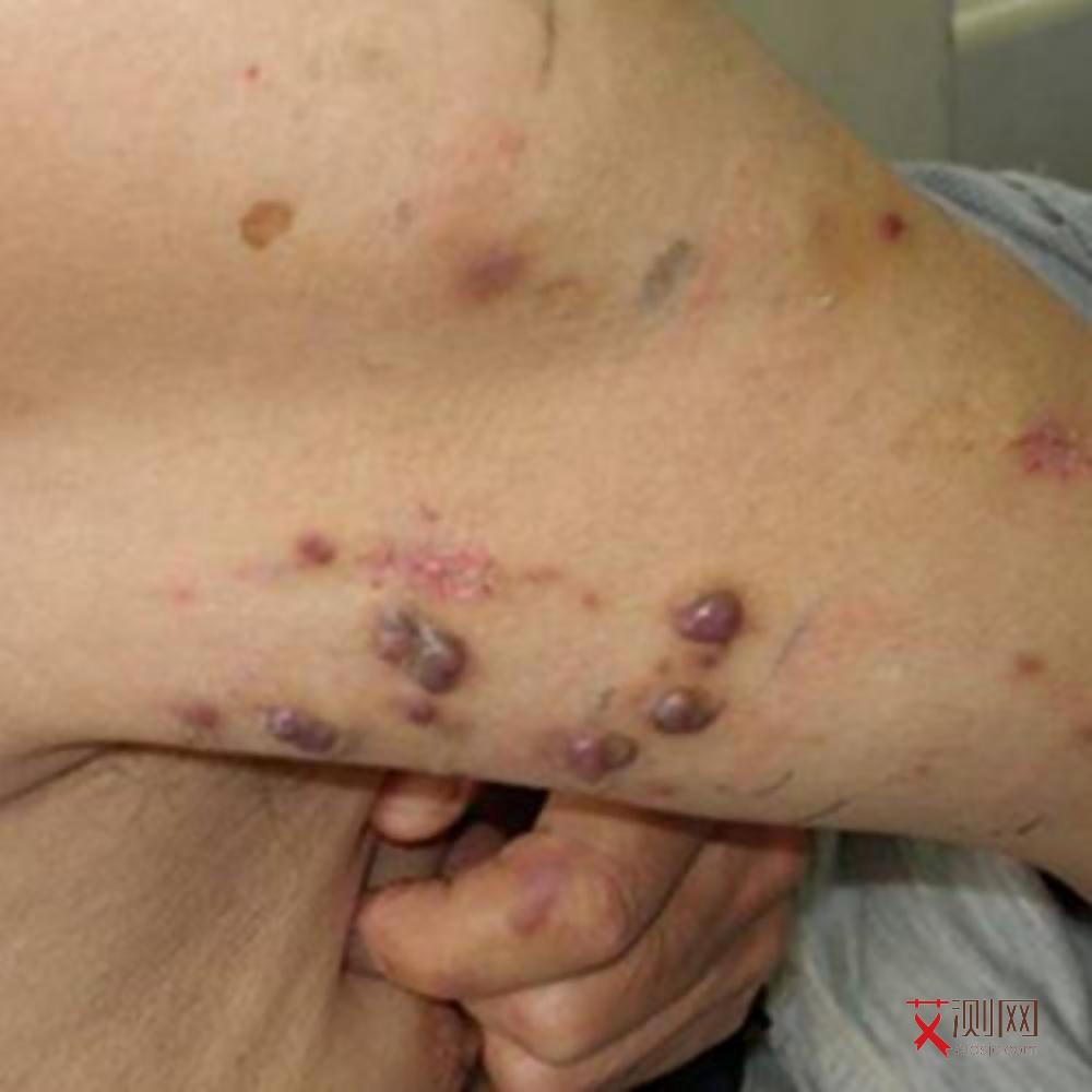 有在疾控中心感染艾滋病的吗现在