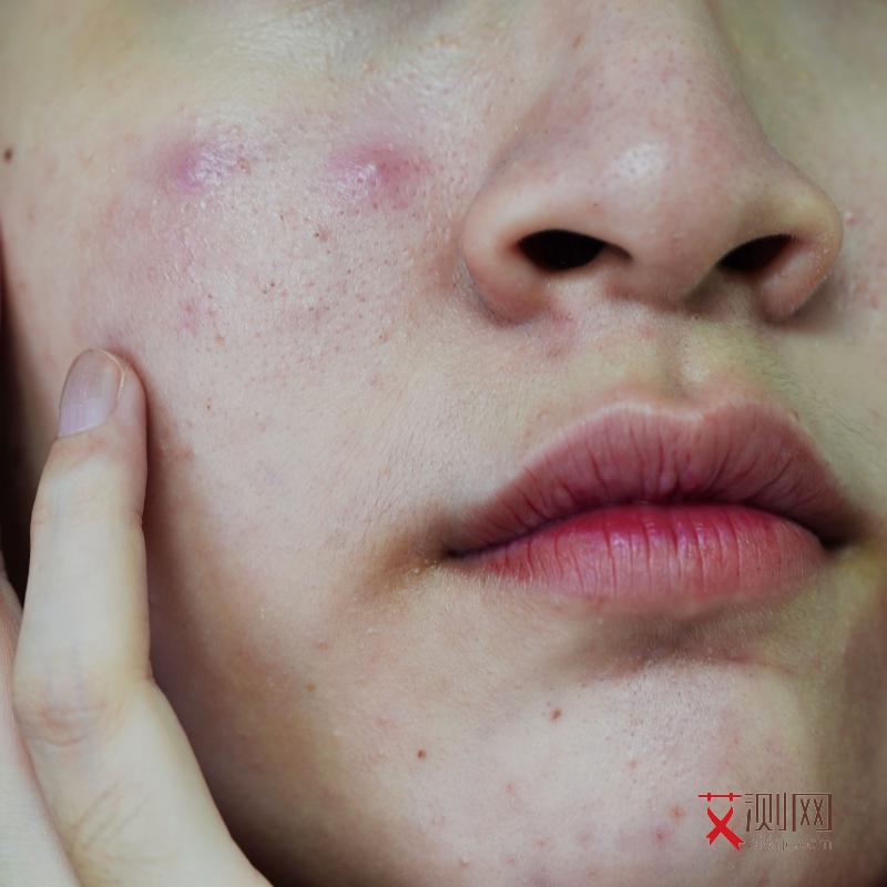 艾滋病皮疹挠了会变大吗会传染吗图片