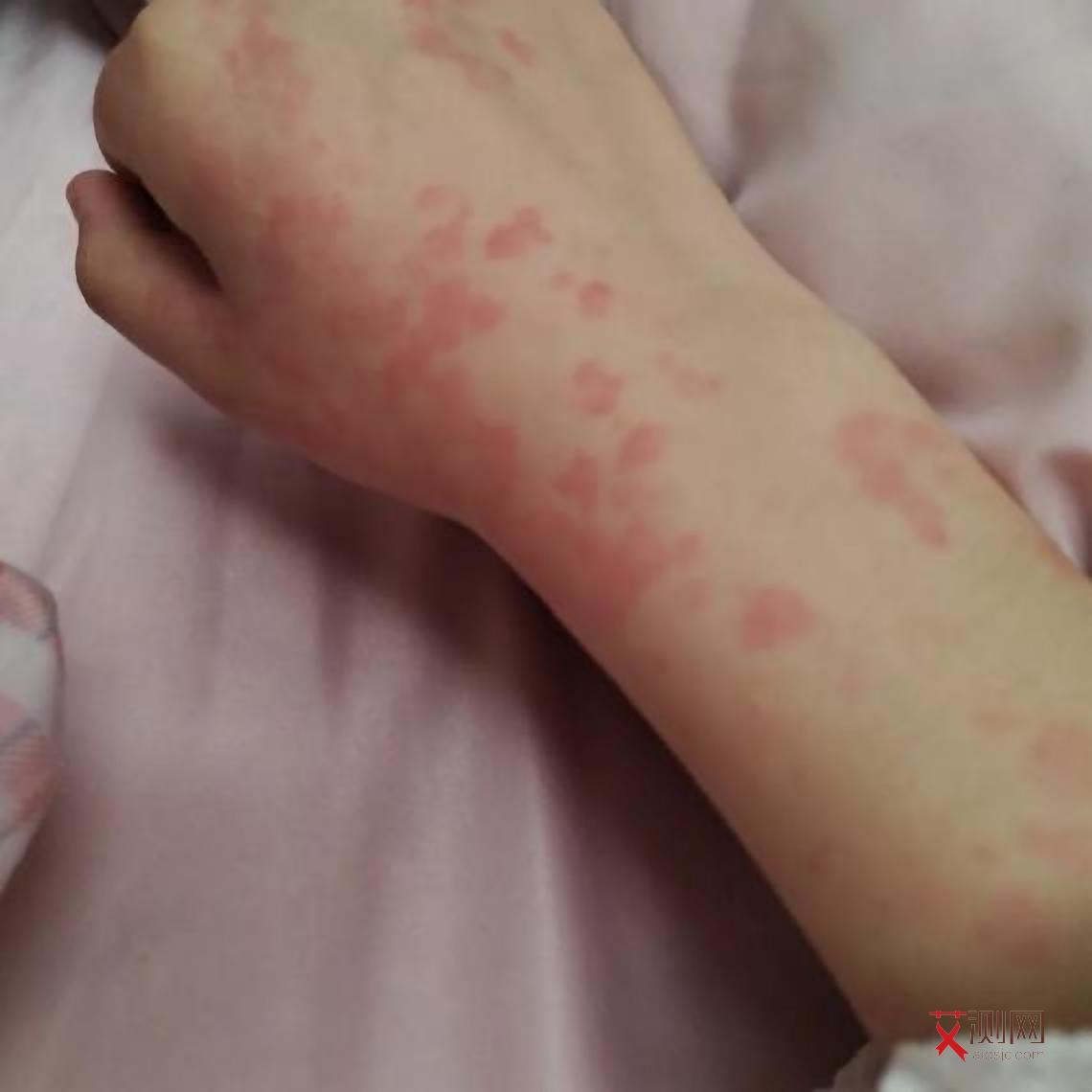 艾滋病有什么反应男性女性