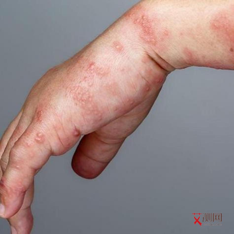 艾滋病的病症是啥样的