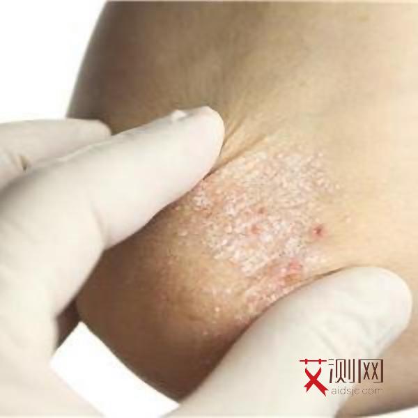 艾滋病患者的口腔表现最常见为