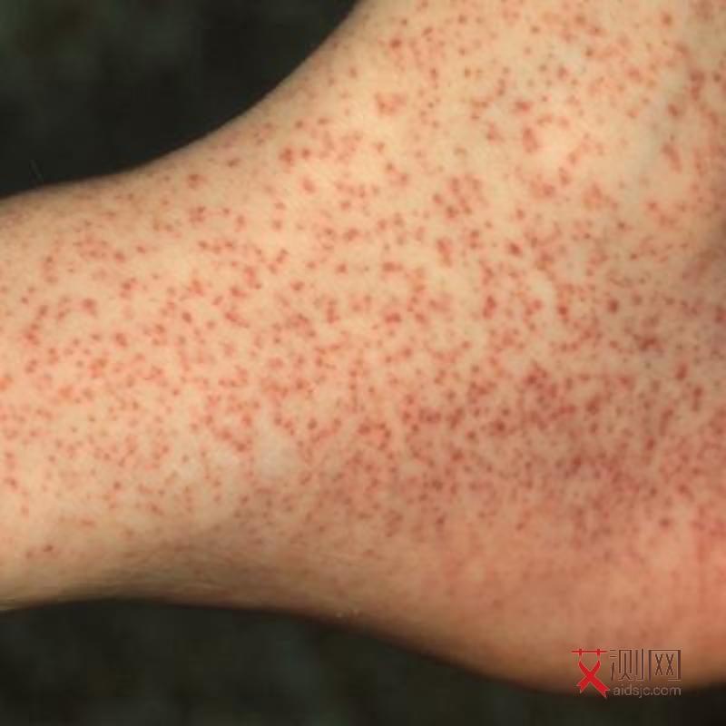艾滋病腿上红点会痒吗