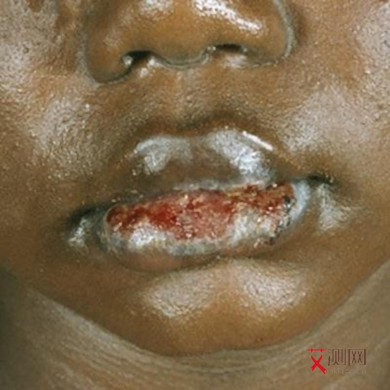 艾滋病淋巴多久会出现皮疹