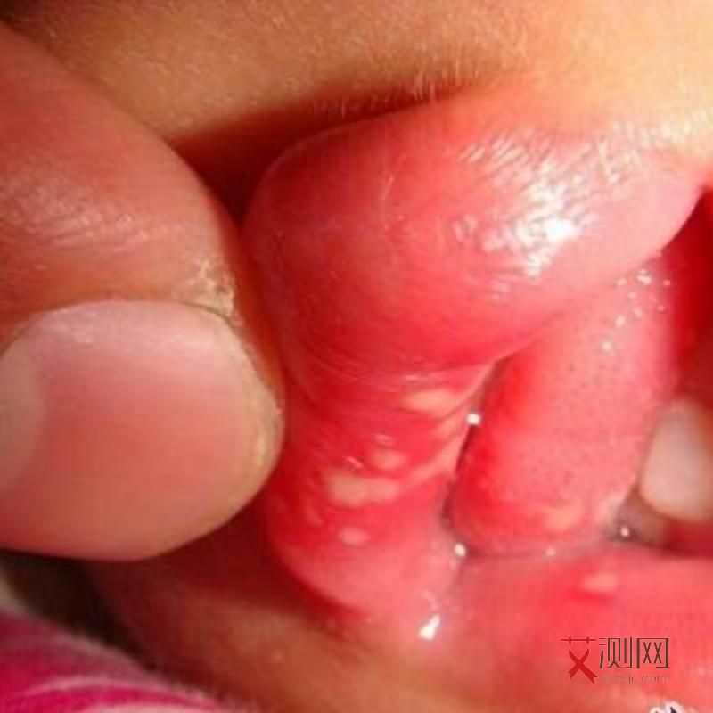 艾滋病会不会身体发痒起红点