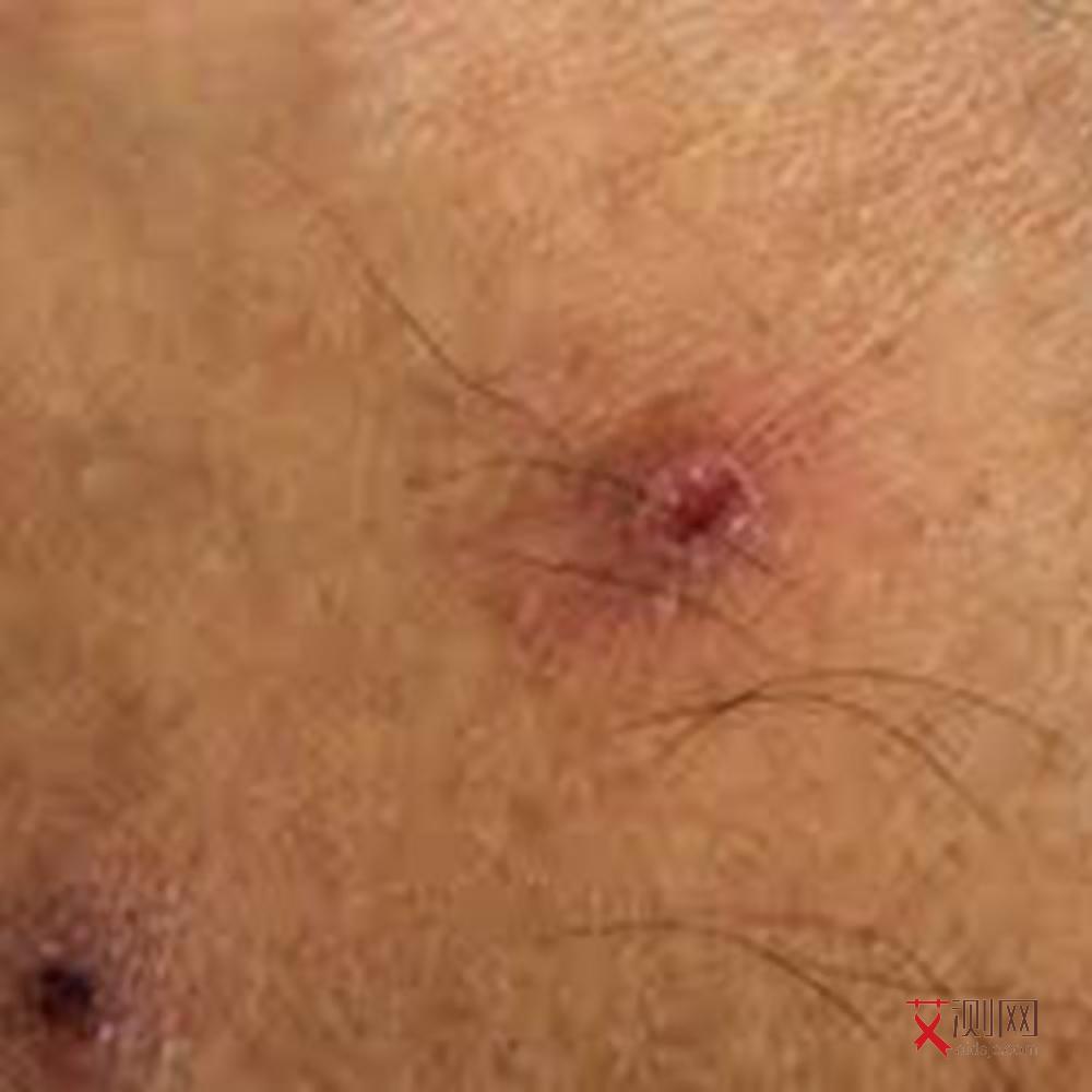 艾滋病的黑色斑点图片和症状