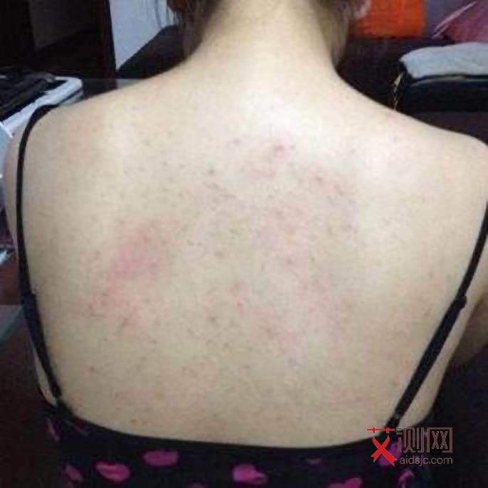 艾滋病出红点会痒吗会传染吗