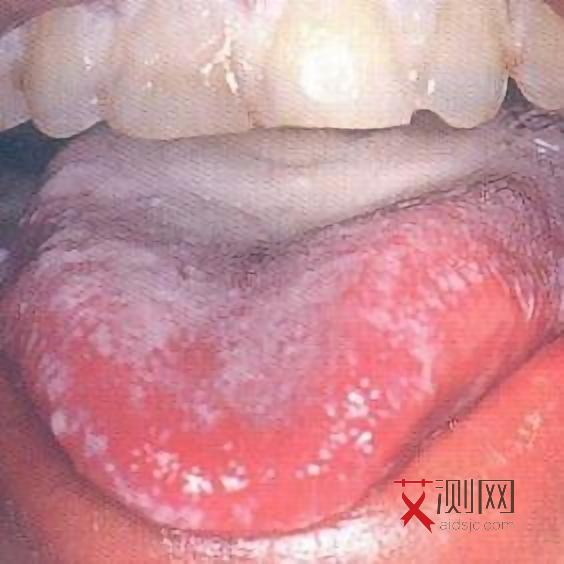 艾滋病最真实的症状表现有哪些呢男性