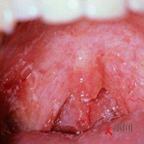 艾滋病的早期特征