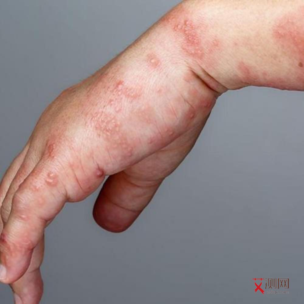 艾滋病下面有什么特征表现症状图片大全