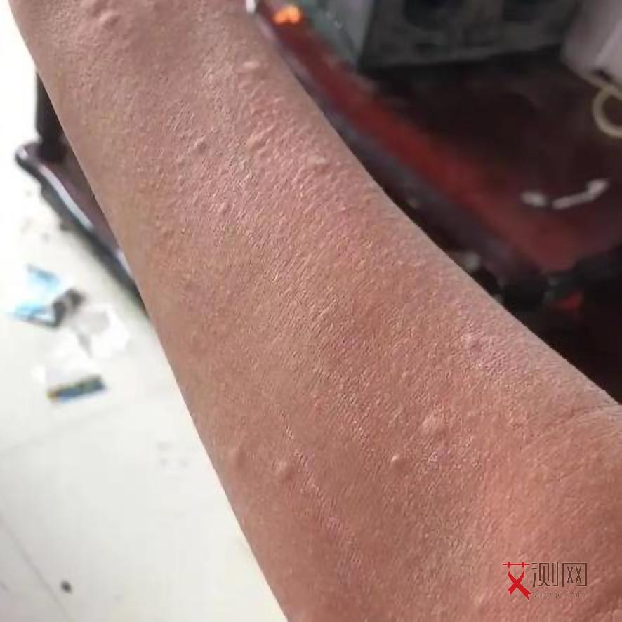 艾滋病患者女性有什么症状吗