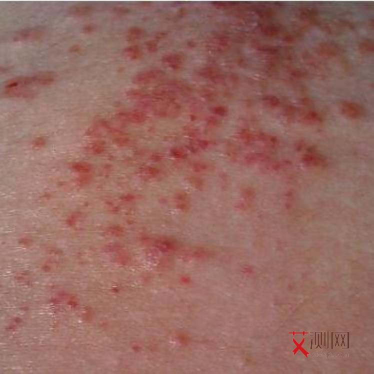 艾滋病皮肤病变图片和症状大全
