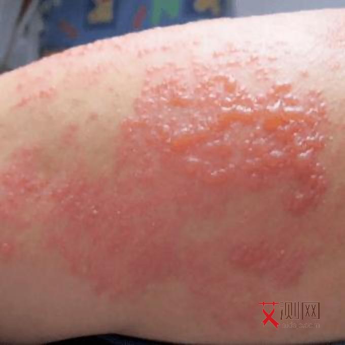 被小姐传染艾滋病