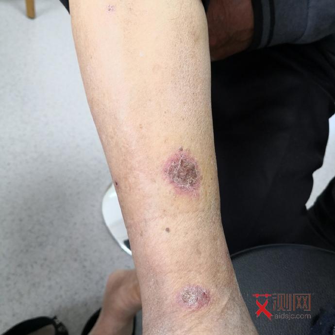 艾滋病前期身体反应是什么样的症状