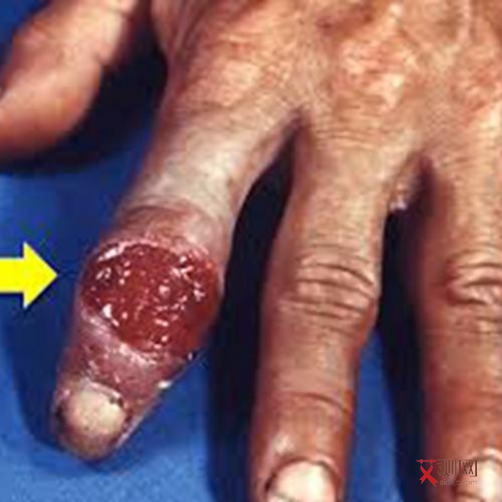 艾滋病患者在口腔易发生的疾病不包括下列哪项