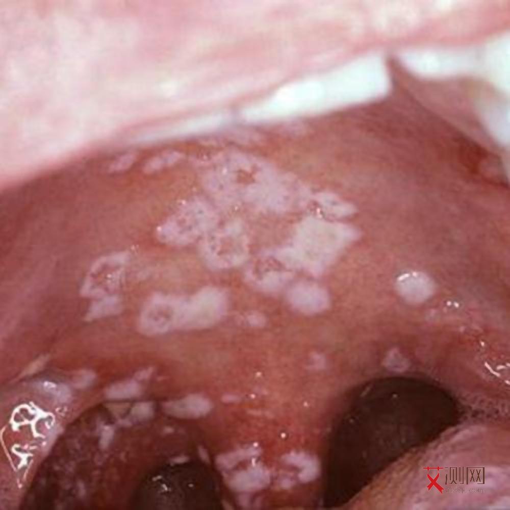 得了艾滋病有什么样的症状图片