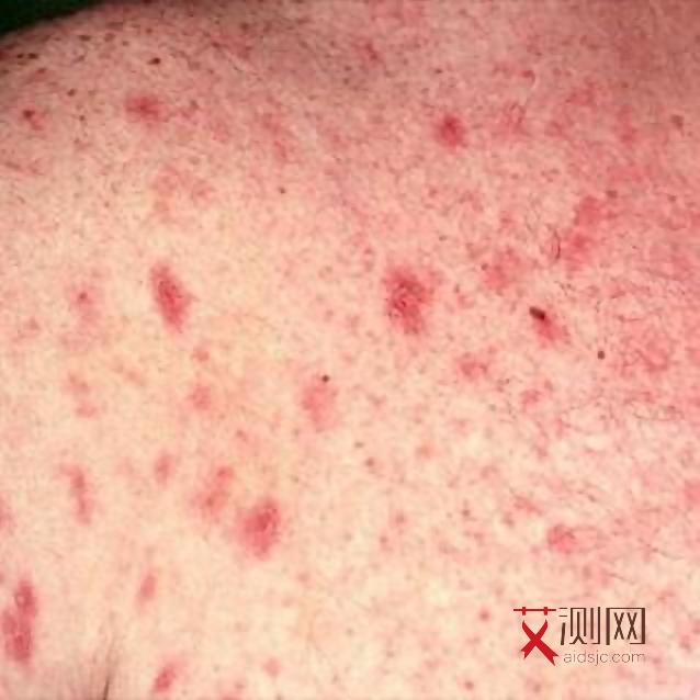 如何检查男生有没有艾滋病毒